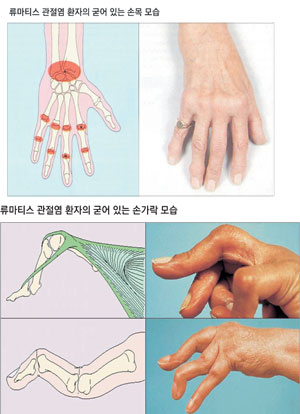 류마티스관절염으로 손가락 관절 마디에 결절이 생겼다.