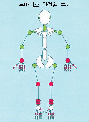 붉은 색으로 표시된 관절 부위는 류마티스 관절염 발생이 80% 이상, 녹색 부위는 50~80%에 이른다.