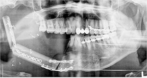 턱뼈를 떼낸 구강암 환자에게 다른 부위에서 가져온 뼈와 피부를 이식한 뒤의 X-선 모습.