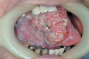구강암 중 혀에 생긴 암.