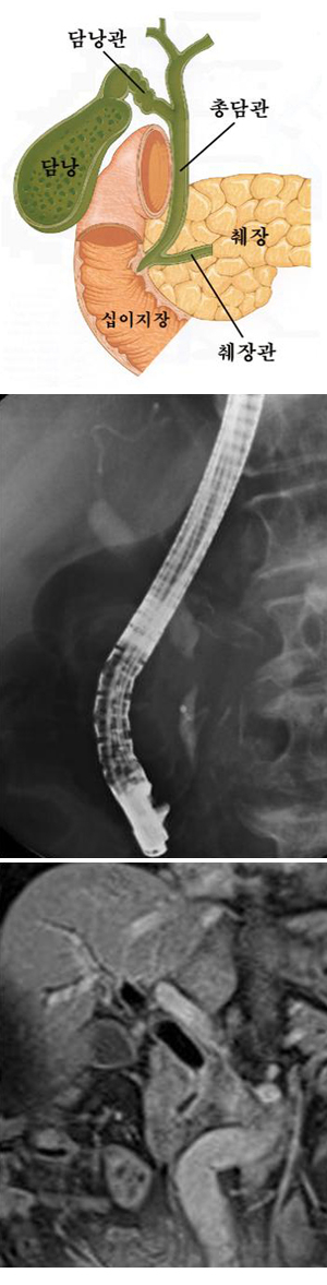 담즙이 배출되는 총담관의 중간 부분에 협착이 보이면서 담관벽이 두꺼워져 있고 위쪽 담관이 부풀어있는 것을 볼 수 있다. 담관을 가로막고 있는 것이 암덩어리이다.
