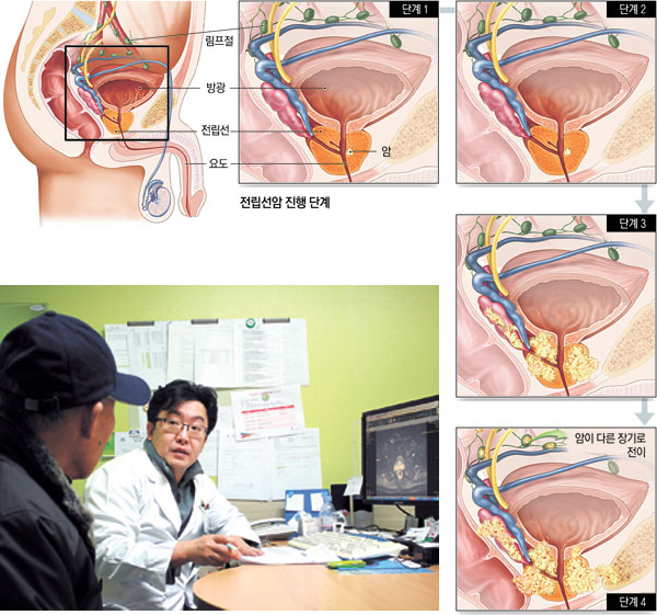 평균 연령이 높아지면서 전립선암에 걸리는 노인 환자가 급격히 증가했다. 건강상태가 좋아서 기대 수명이 10년 이상이라면 80세 이후에도 수술을 권한다.