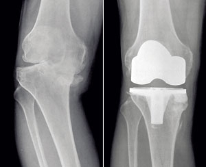 인공 무릎관절 수술 전(왼쪽)과 수술 후 X선 사진.