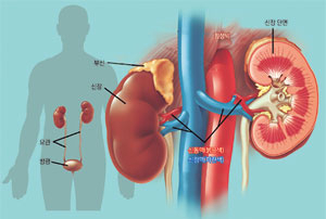 신장은 체내 수분 조절, 노폐물 배출, 산-알칼리 조절 등 중요한 기능을 한다. 하지만 만성 신장질환이 상당히 진행돼 신장 기능이 망가질 때까지 스스로 알아차리기 어렵다. 경북대병원 제공