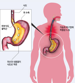 위산이 역류하는 위