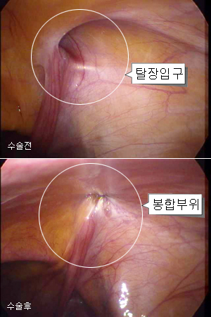 ▲태아의 장기는 엄마 뱃속에서 서서히 제자리를 찾아간다. 그러나 장기가 이동하면서 막혀야 할 길이 남아있거나 복벽이 제대로 닫히지 않으면 장이 삐져나오는 탈장이 발생한다.