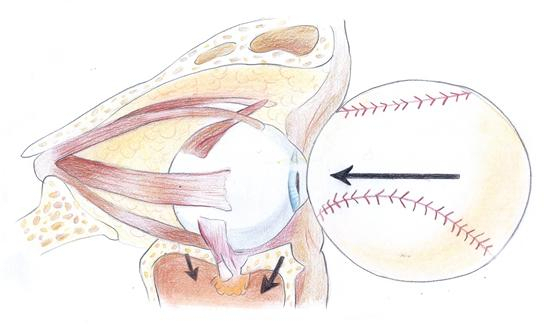 야구공으로 눈을 맞으면 눈동자에 압력이 전해져 안와골절이 발생한다.