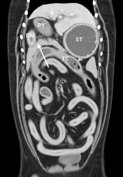 개의 복강(CT) 사진. 췌장(화살표), 위(ST), 십이지장(DU), 대장(TC) 이미지출처: https://todaysveterinarypractice.com