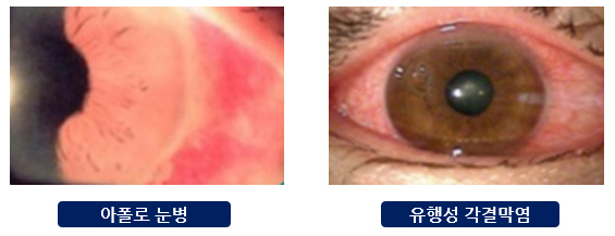 아폴로 눈병 및 각결막염 이미지