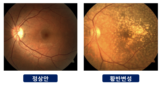 정상안 및 황반변성 이미지