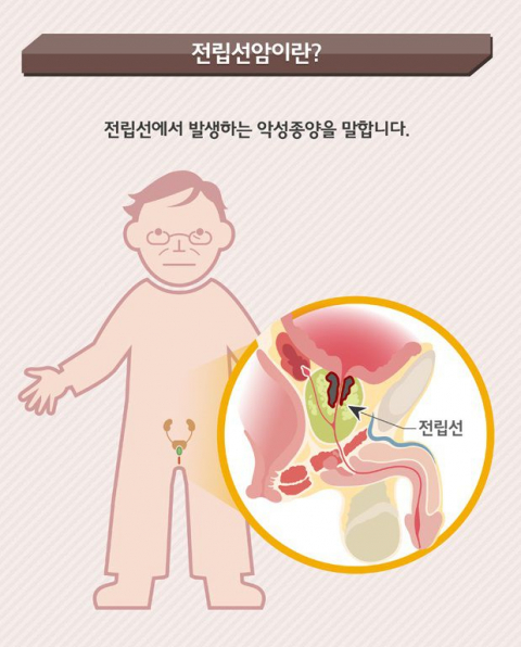 전립선암. 국가암정보센터 제공