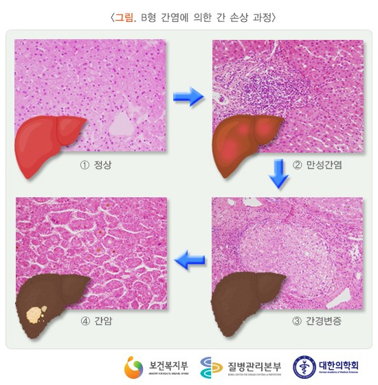 B형 간염에 의한 간 손상 과정