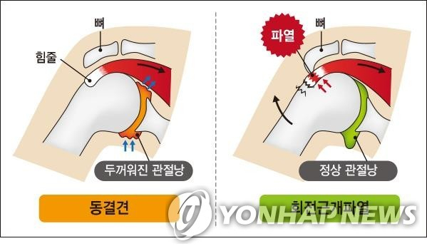 박근혜 전 대통령의 수술 원인질환은 오십견이 아니라 회전근개 파열이다. 연합뉴스