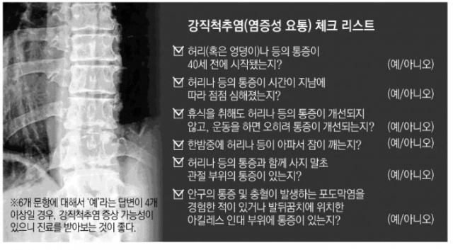 강직척추염 환자 X-ray 사진