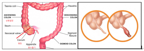 사람의 맹장과 충수돌기의 해부학적 구조(사진 좌측)와 정상 충수돌기와 충수염(우측) (사진출처: https://www.clien.net)
