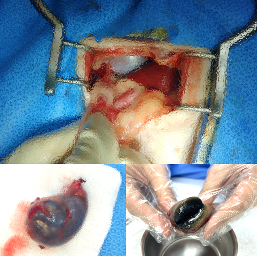 또야의 수술과정을 촬영한 사진. (윗 사진)담낭 주변의 간조직과 장간막의 유착이 확인되었다. (아래사진)수술 후 적출된 담낭을 절개 해보면 벽이 두터워보이지만 쉽게 으스러지는 담낭벽의 변성(Gallblader mucocele)이 관찰된다. 탑스동물메디컬센터 제공.