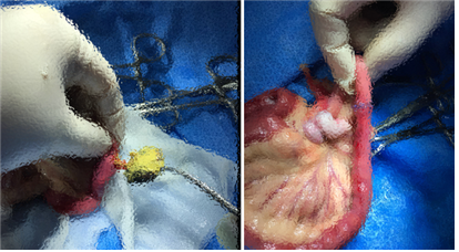 터키의 수술장면. 왼쪽 사진은 소장의 안쪽 지름보다 3배가 큰 이물을 제거하는 과정. 오른쪽 사진은 이미 괴사된 폐색 부위를 절제 후 건강한 장관을 연결해주는 장문합술이 이루어진 수술 과정. 소장을 폐색시킨 이물질은 자두씨였다. 탑스동물메디컬센터 제공.