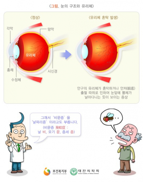 눈의 구조와 유리체. 질병관리본부 국가건강정보포털 제공