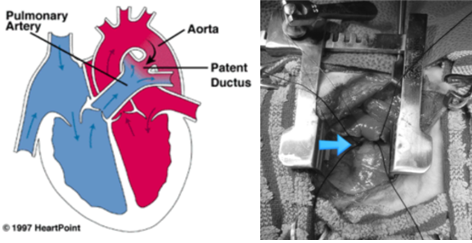 (왼쪽사진)선천성 동맥관개존증의 모식도. (오른쪽사진)나나의 실제 수술 중 PDA 혈관 결찰 모습. 탑스동물메디컬센터 제공.