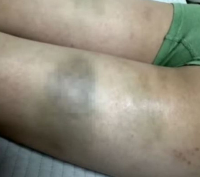 초등학생 신체에 피멍이 들 정도로 체벌해 고소를 당한 교사가 적반하장식으로 나와 공분을 사고 있다. JTBC 