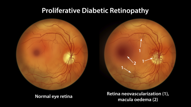 정상 망막(왼쪽)과 당뇨망막병증에 걸린 망막(오른쪽). 클립아트코리아 제공.