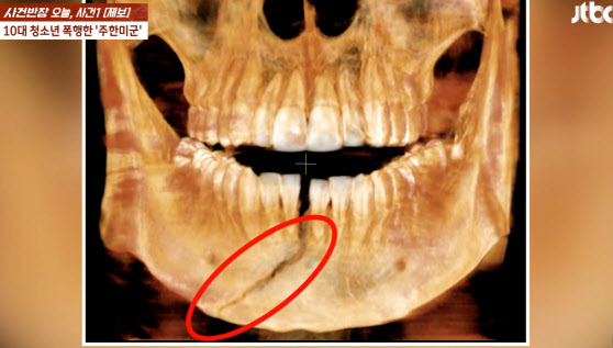 주한미군에 맞아 턱뼈가 골절된 10대 남학생의 엑스레이 사진 JTBC 
